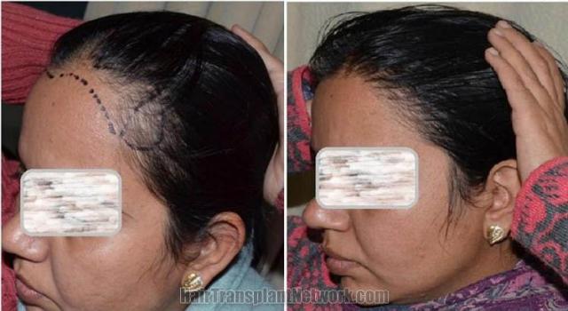 Female hair transplantation surgery before and after images