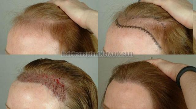 Hair transplantation surgery before and after photos