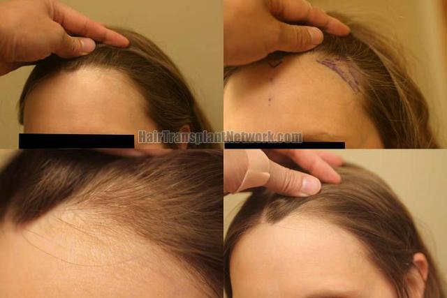 Hair transplantation surgery before and after photos