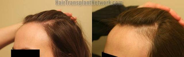 Female hair transplantation surgery before and after images