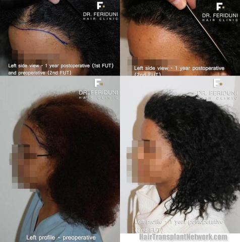 Hair transplantation surgery before and after pictures