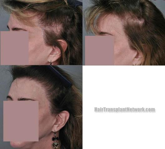 Hair transplantation surgery before and after pictures