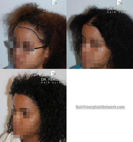 Hair transplant surgery before and after photos