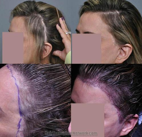 Hair transplantation surgery before and after photos