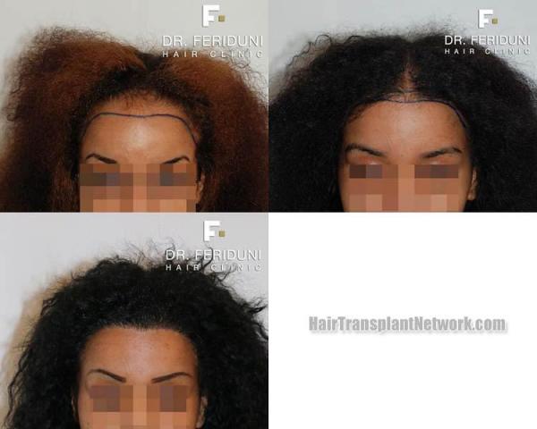 Front view - Before and after hair transplant surgery result images