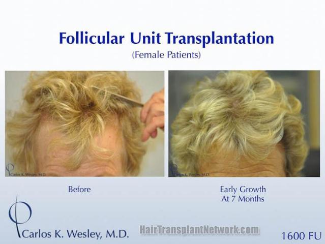 Hair restoration procedure before and after results