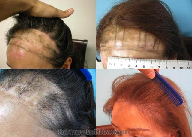 Hair transplantation surgery before and after pictures