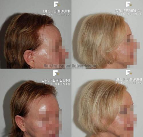 Hair transplantation surgery before and after images