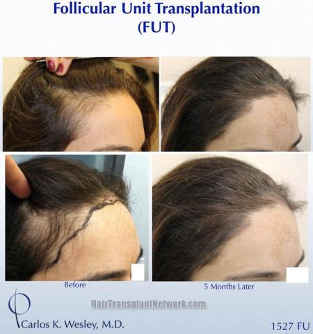 Female hair transplantation surgery before and after images