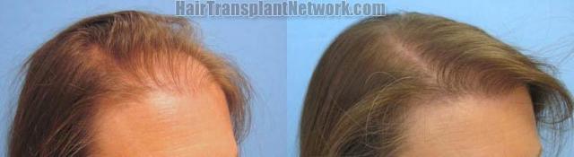 Female hair transplantation surgery before and after images