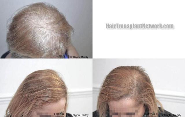 Hair transplantation surgery before and after images