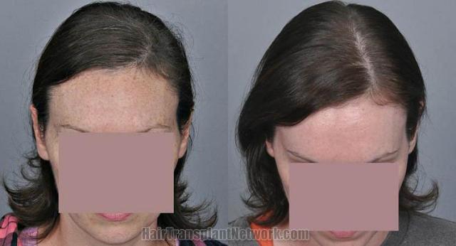 Hair transplantation surgery before and after pictures