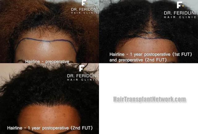 Hair restoration procedure before and after results