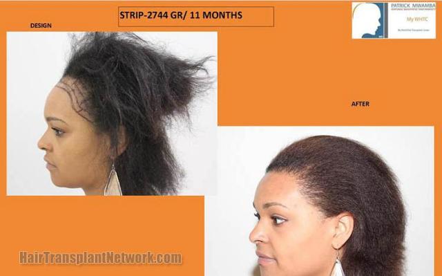 Hair transplantation surgery before and after pictures