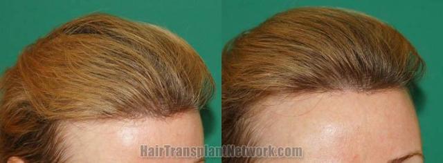 Hair transplantation surgery before and after images