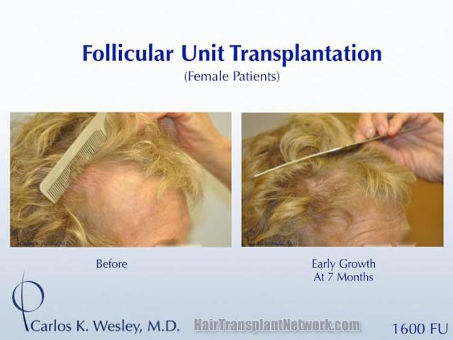 Hair transplantation surgery before and after photos