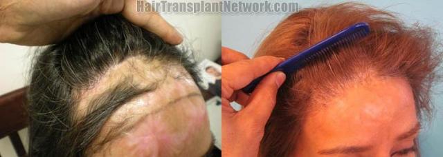 Hair transplantation surgery before and after images