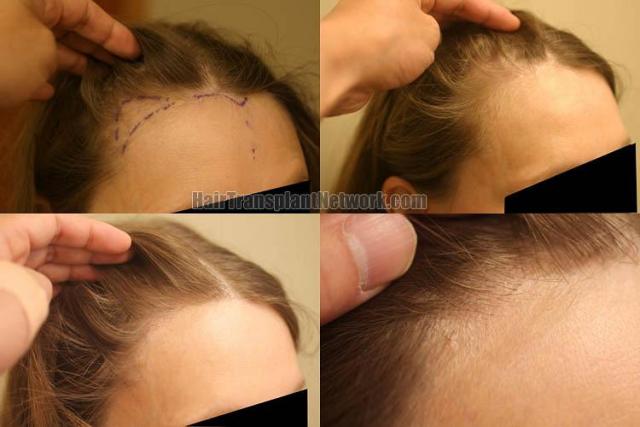 Hair restoration procedure before and after results