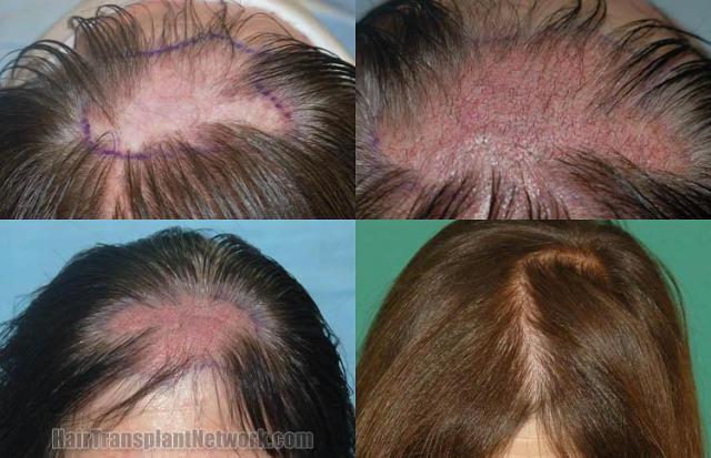 Hair restoration procedure before and after pictures