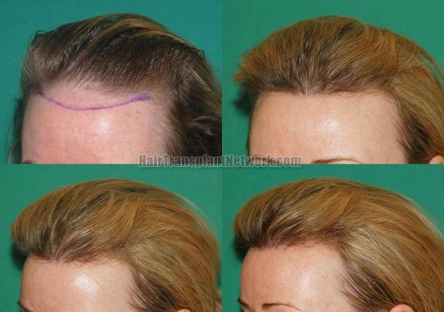 Hair restoration procedure before and after pictures