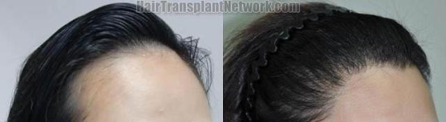 Hair transplantation surgery before and after photos