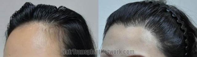 Hair transplantation surgery before and after images