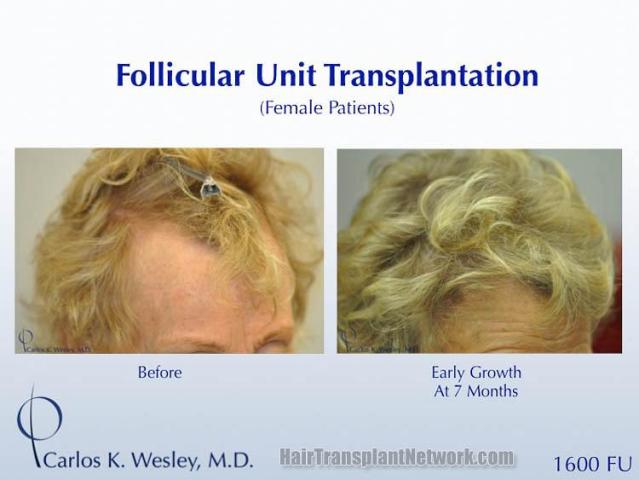 Hair transplantation surgery before and after pictures