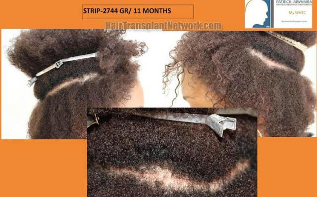 Hair restoration procedure before and after pictures