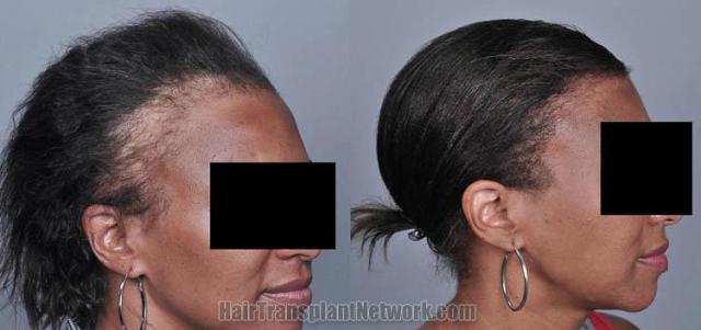 Hair transplantation surgery before and after images