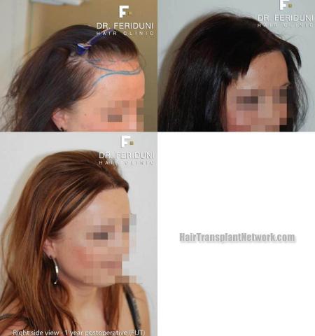 Hair restoration procedure before and after pictures