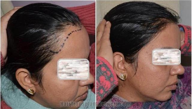 Female hair transplantation surgery before and after images