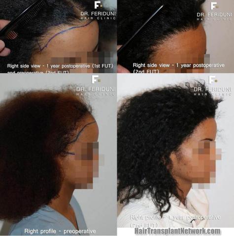 Hair transplantation surgery before and after images