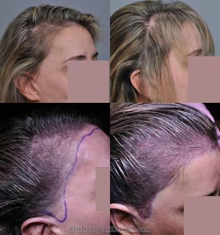 Hair transplantation surgery before and after images