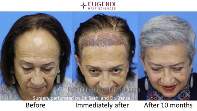 Female hair transplantation surgery before and after images