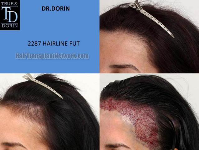 Hair restoration procedure before and after pictures