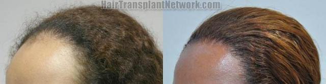 Female hair transplantation surgery before and after photos