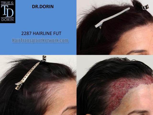 Hair transplantation surgery before and after pictures