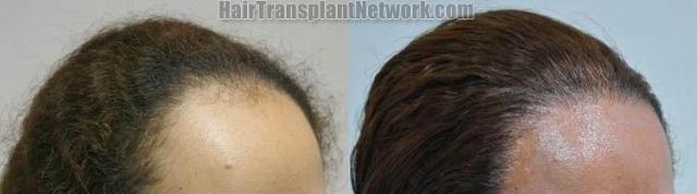 Female hair transplantation surgery before and after images