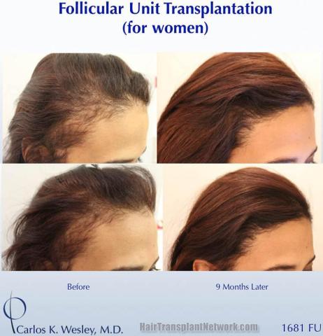 Female hair transplantation surgery before and after images