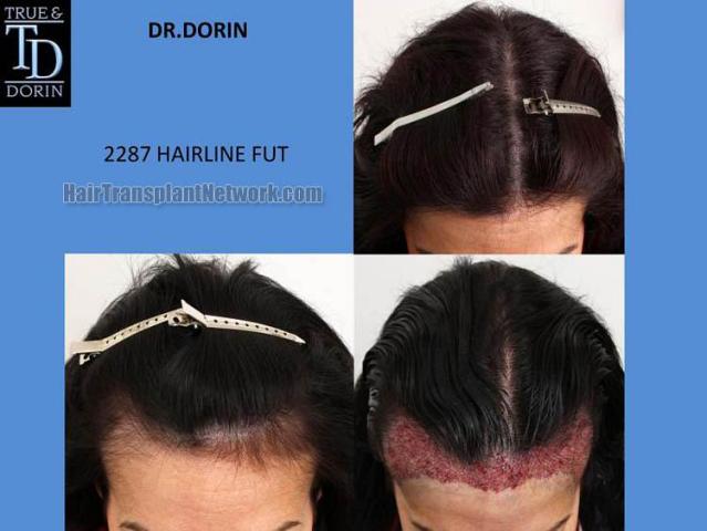 Hair transplantation surgery before and after images