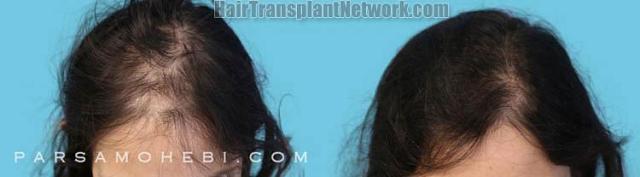 Female hair transplantation procedure before and after result