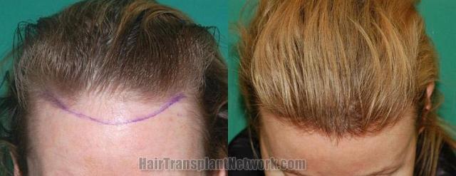 Hair restoration procedure before and after results