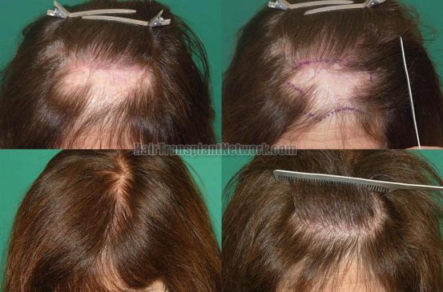 Hair transplantation surgery before and after photos