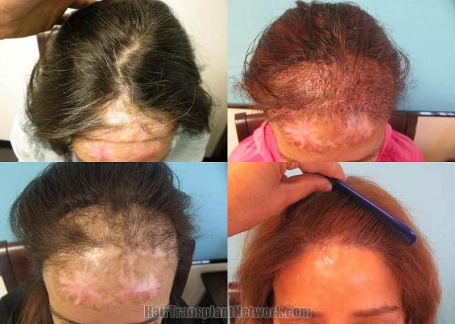 Hair transplantation surgery before and after photos