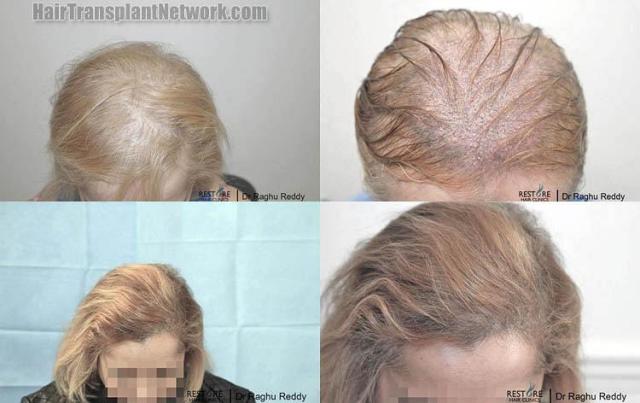 Hair transplantation surgery before and after photos