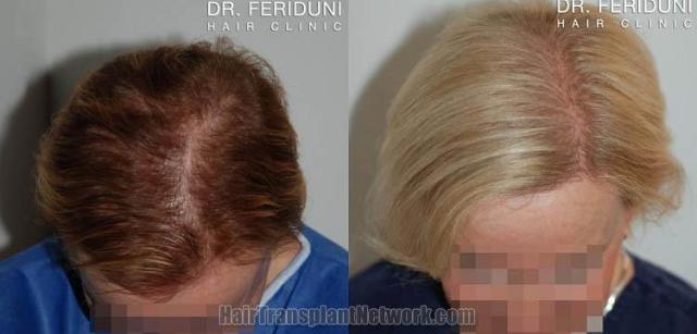 Hair transplantation surgery before and after photos