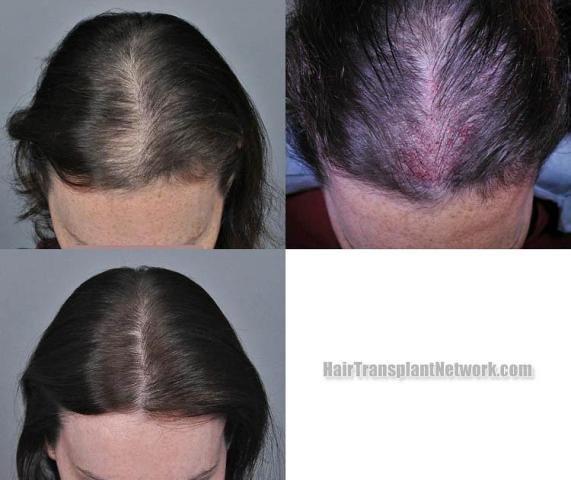 Hair restoration procedure before and after pictures