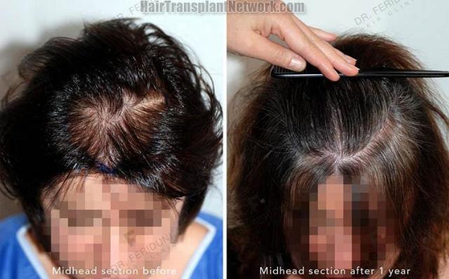 Female hair transplantation procedure before and after result