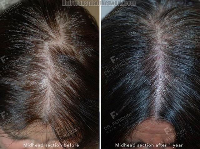 Female hair transplantation surgery before and after images