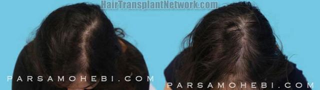 Female hair transplantation surgery before and after images